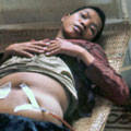 Patient with abdominal tap